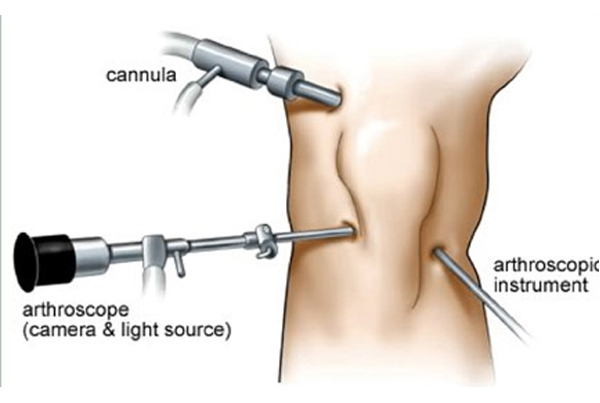 Knee Arthroscopy