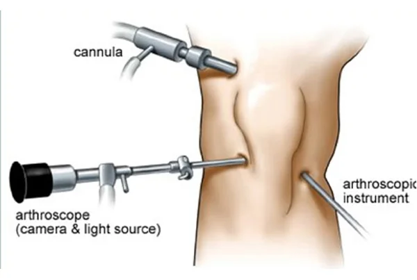 Knee Arthroscopy