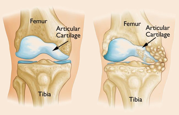 Knee Osteotomies