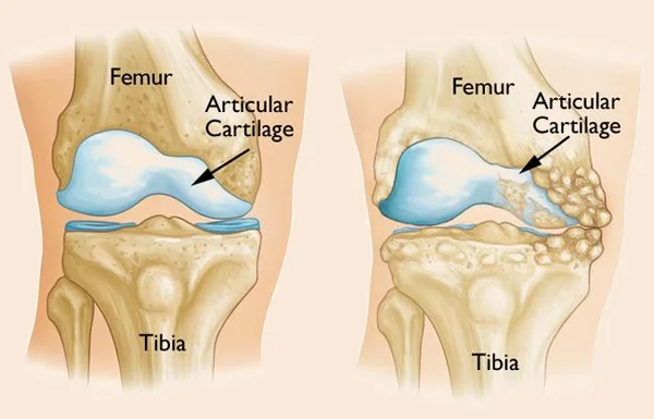 Knee Osteotomies