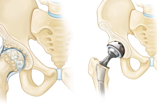 Total Hip Replacement Surgery